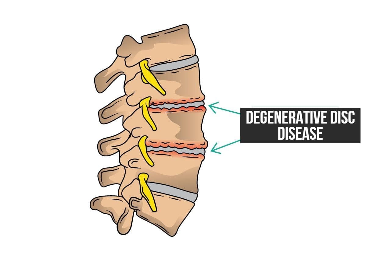 best running shoes for degenerative disc disease