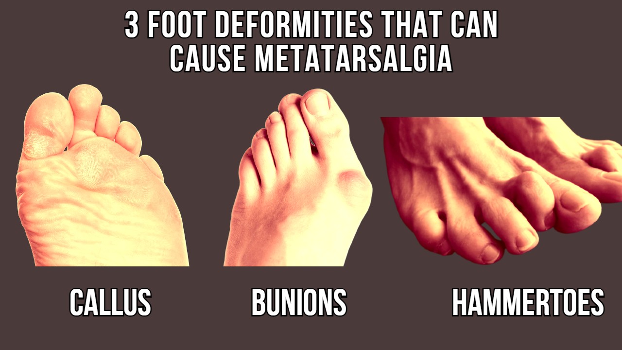 causes of metatarsalgia